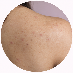 Body acne