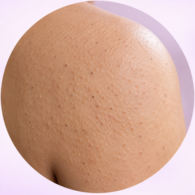 Clogged pores