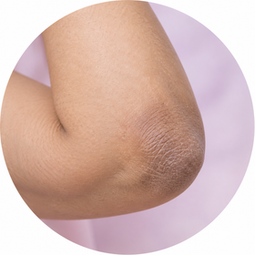 Dark-looking elbows