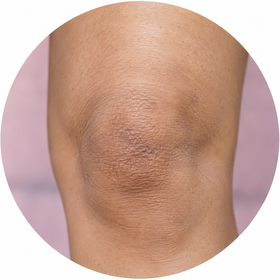 Rough knees